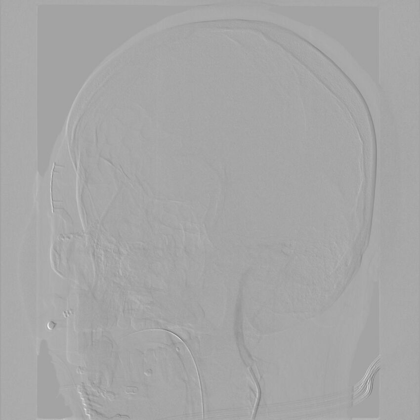 Caroticocavernous fistula - direct (Radiopaedia 61660-69666 Oblique Left ICA 9).jpg