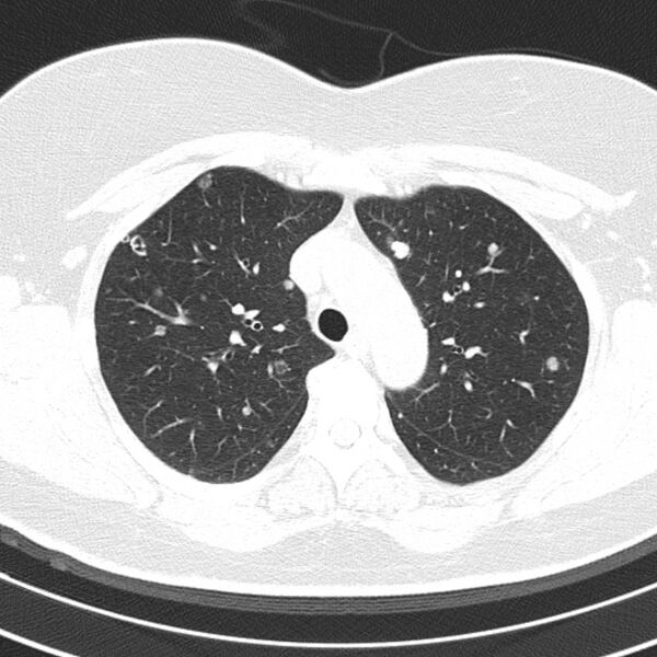 File:Cavitating pulmonary metastases (Radiopaedia 17796-17555 Axial lung window 4).jpg