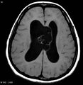 Central neurocytoma (Radiopaedia 4355-6613 B 1).jpg