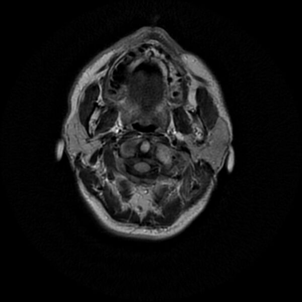 File:Central neurocytoma (Radiopaedia 67618-77021 Axial FLAIR 1).jpg