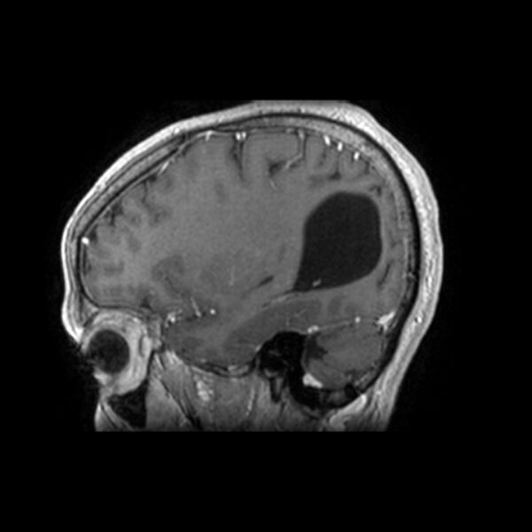 File:Central neurocytoma (Radiopaedia 67618-77021 Sagittal T1 C+ 22).jpg