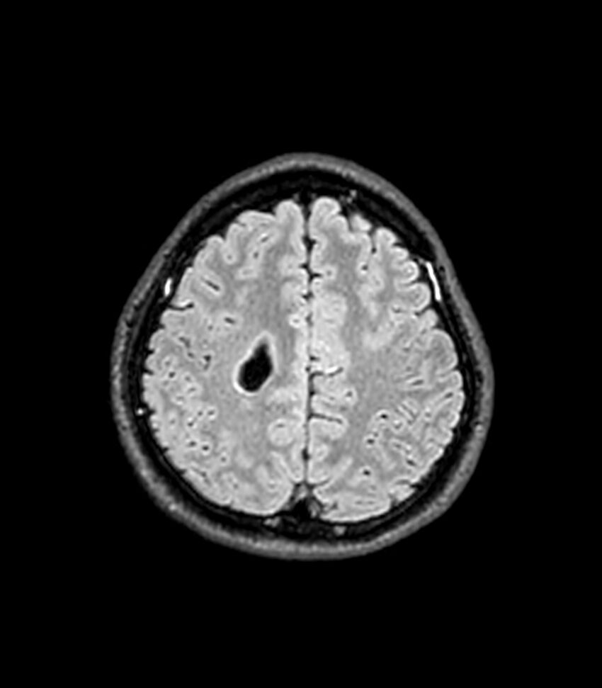 Central neurocytoma (Radiopaedia 79320-92380 Axial FLAIR 85).jpg