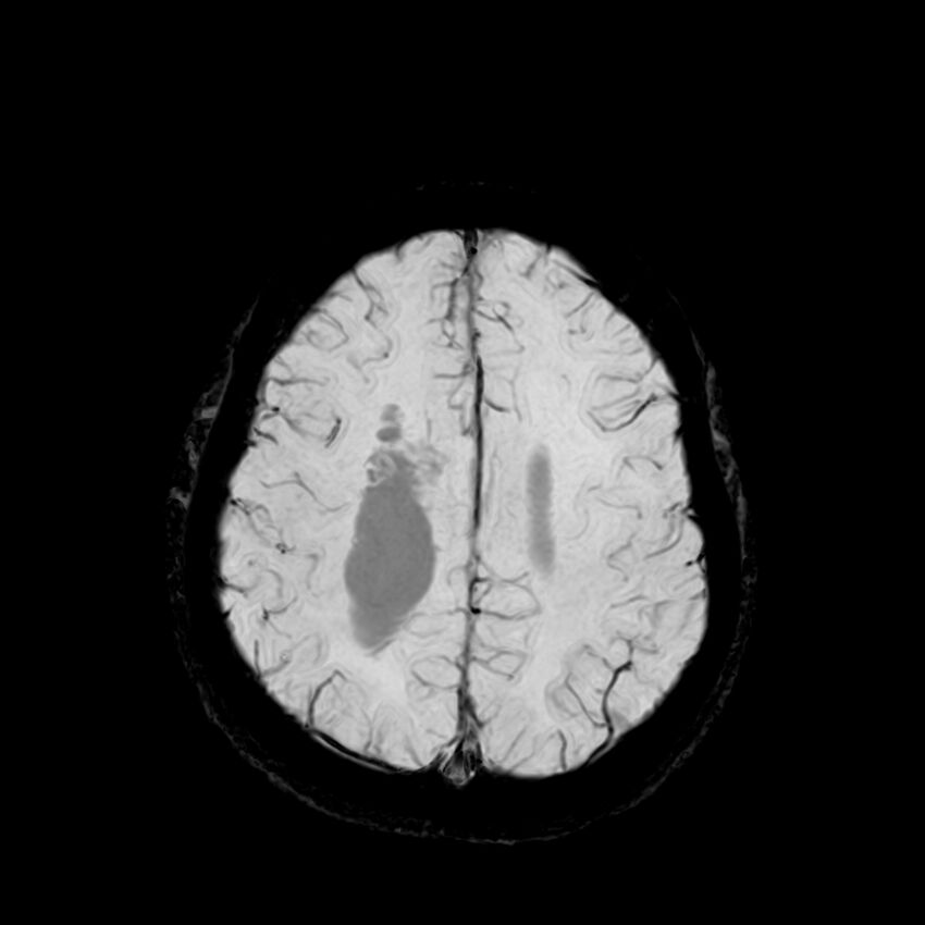 Central neurocytoma (Radiopaedia 79320-92380 Axial SWI 106).jpg