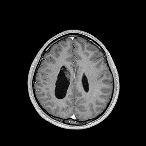 File:Central neurocytoma (Radiopaedia 79320-92380 Axial T1 C+ 168).jpg