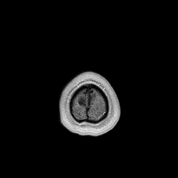 File:Central neurocytoma (Radiopaedia 79320-92380 Axial T1 C+ 227).jpg
