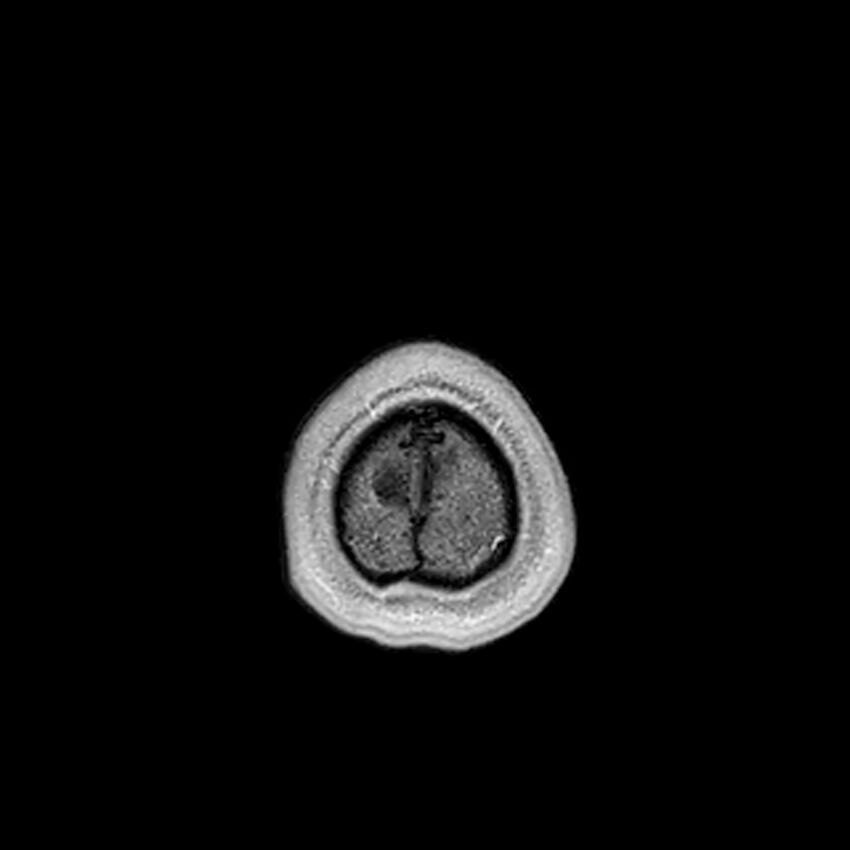 Central neurocytoma (Radiopaedia 79320-92380 Axial T1 C+ 227).jpg