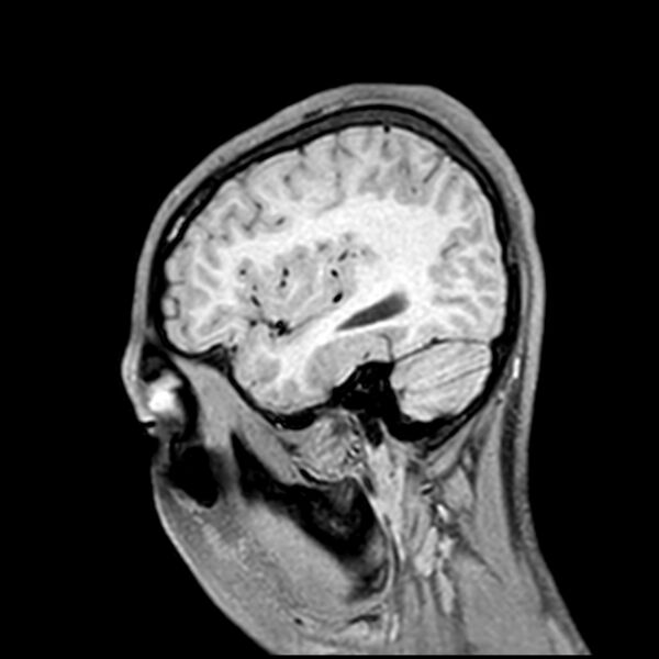 File:Central neurocytoma (Radiopaedia 79320-92380 Sagittal T1 202).jpg