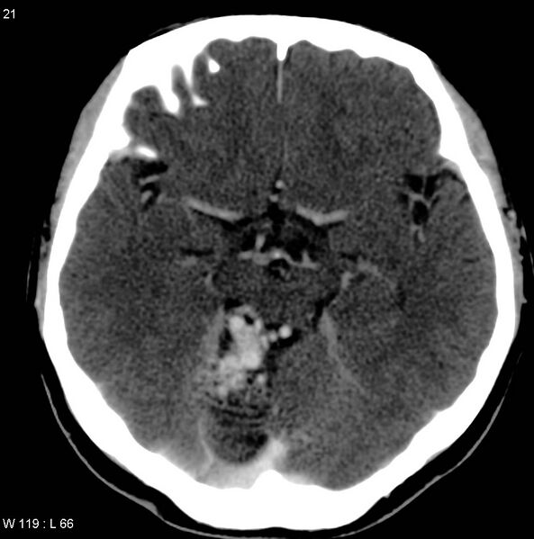 File:Cerebellar arteriovenous malformation (Radiopaedia 5220-36607 A 8).jpg