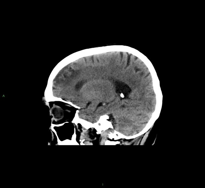 File:Cerebral amyloid angiopathy-associated lobar intracerebral hemorrhage (Radiopaedia 58529-65681 B 17).jpg