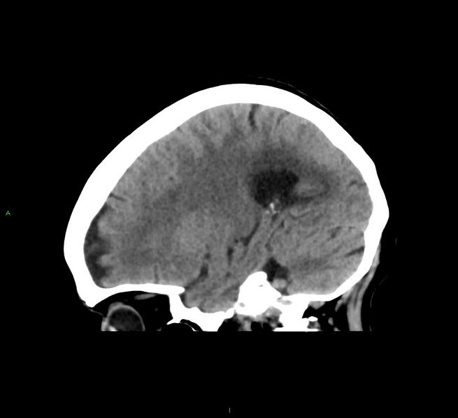 File:Cerebral amyloid angiopathy-associated lobar intracerebral hemorrhage (Radiopaedia 58563-65727 C 36).jpg