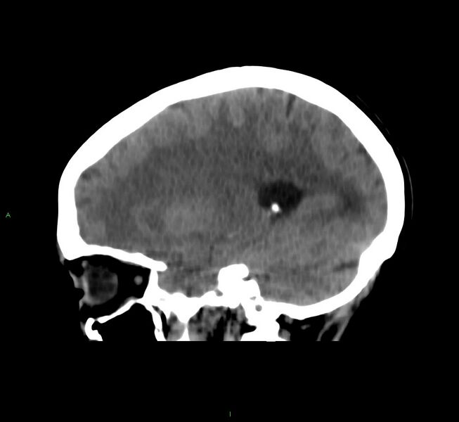 File:Cerebral amyloid angiopathy-associated lobar intracerebral hemorrhage (Radiopaedia 58566-65730 C 34).jpg