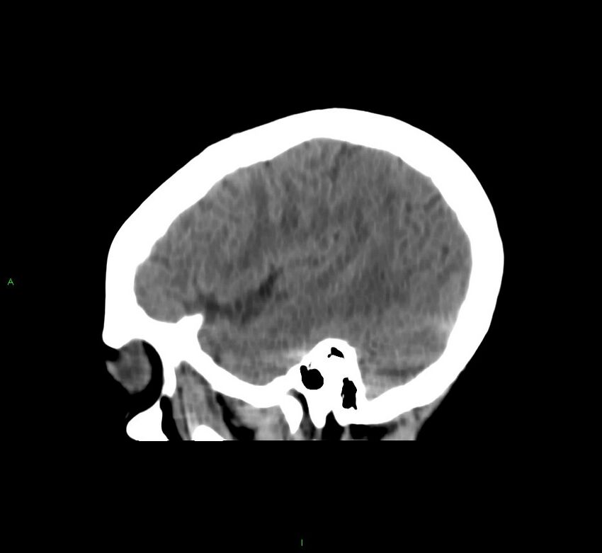 Cerebral amyloid angiopathy-associated lobar intracerebral hemorrhage (Radiopaedia 58566-65730 C 40).jpg
