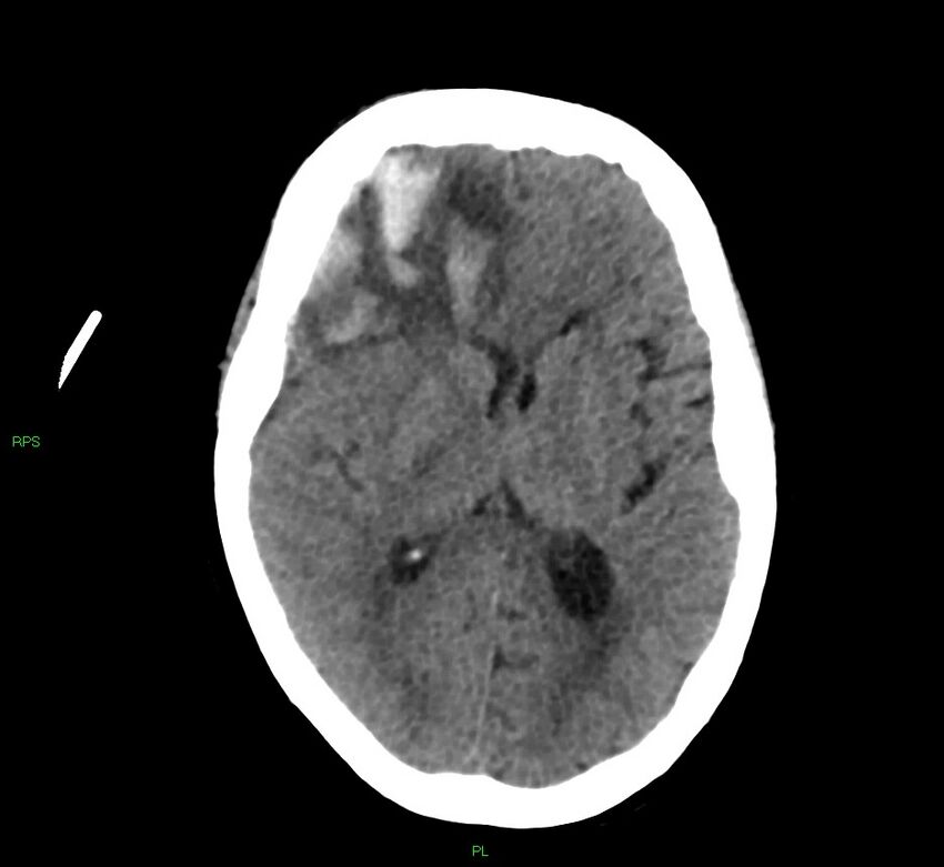 Cerebral amyloid angiopathy-associated lobar intracerebral hemorrhage (Radiopaedia 58569-65734 Axial non-contrast 32).jpg