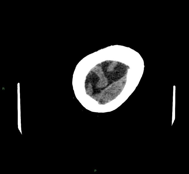 File:Cerebral amyloid angiopathy-associated lobar intracerebral hemorrhage (Radiopaedia 58757-65979 Axial non-contrast 134).jpg
