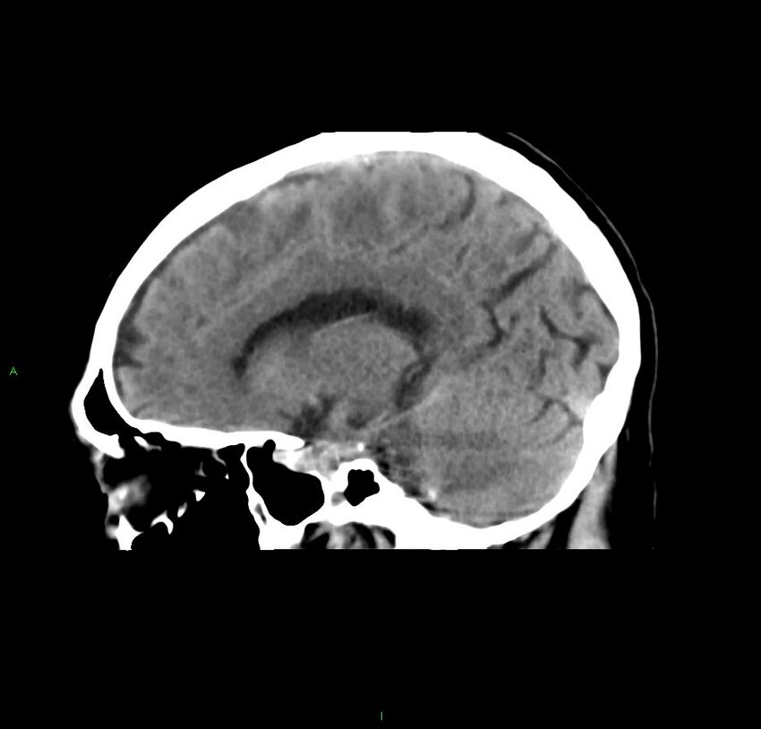 Cerebral amyloid angiopathy-associated lobar intracerebral hemorrhage (Radiopaedia 59356-66716 C 33).jpg