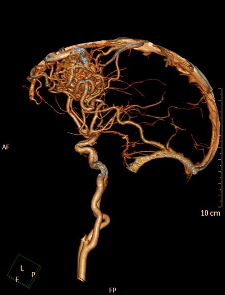 File:Cerebral arteriovenous malformation (Radiopaedia 29531-30031 B 16).jpg