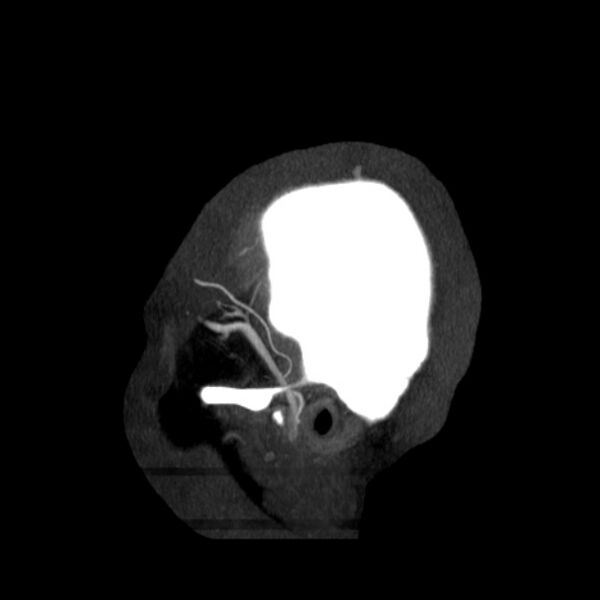 File:Cerebral arteriovenous malformation (Radiopaedia 43729-47189 D 50).jpg