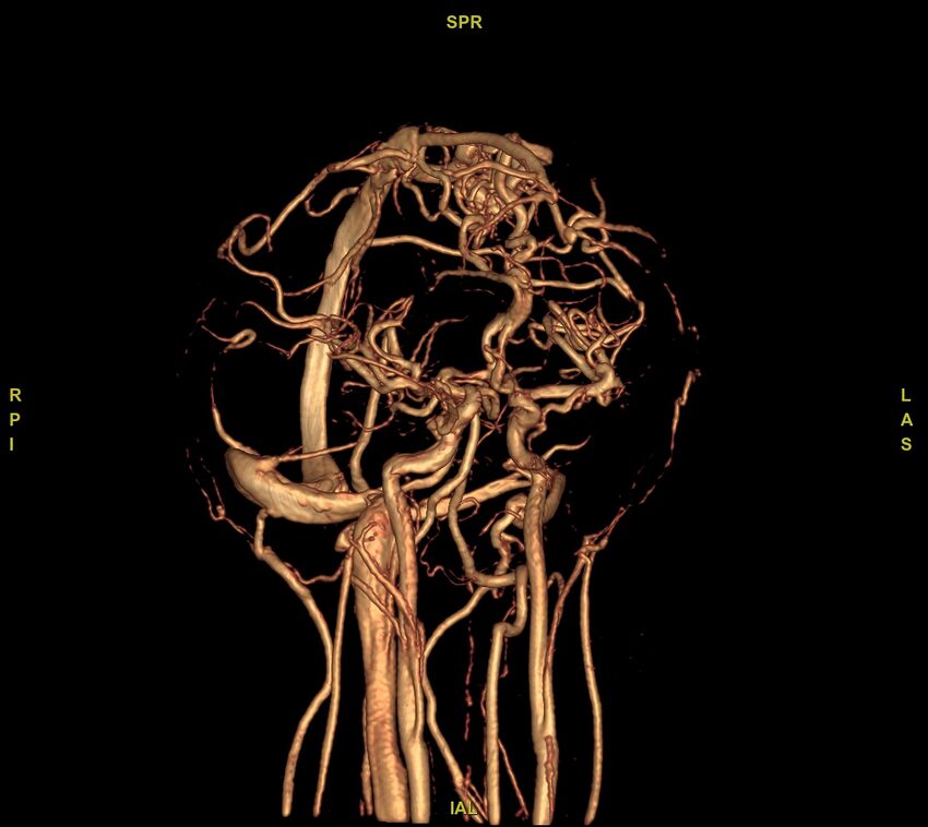 Cerebral arteriovenous malformation (Radiopaedia 61964-70029 VRT 36).jpg
