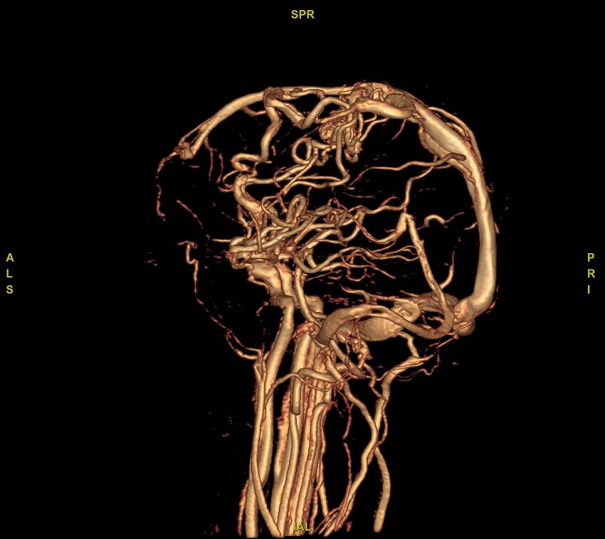 Cerebral arteriovenous malformation (Radiopaedia 61964-70029 VRT 5).jpg