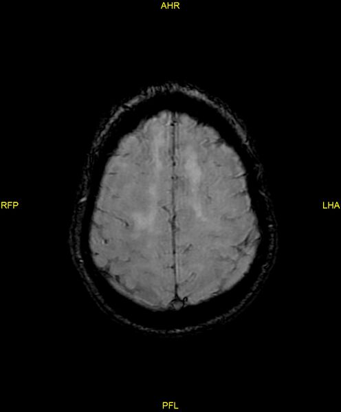 File:Cerebral autosomal dominant arteriopathy with subcortical infarcts and leukoencephalopathy (CADASIL) (Radiopaedia 86108-102054 Axial SWI 85).jpg