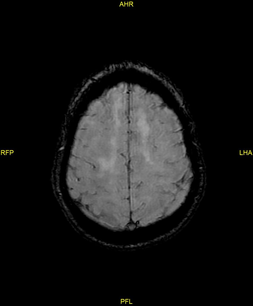 Cerebral autosomal dominant arteriopathy with subcortical infarcts and leukoencephalopathy (CADASIL) (Radiopaedia 86108-102054 Axial SWI 85).jpg