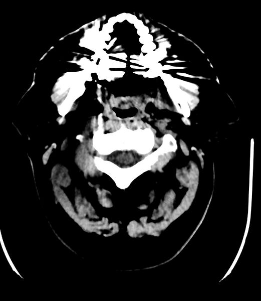 File:Cerebral dural venous sinus thrombosis (Radiopaedia 86514-102575 Axial non-contrast 1).jpg