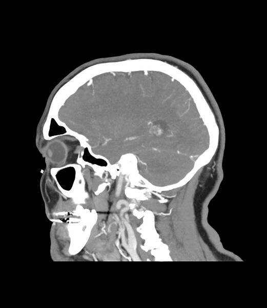 File:Cerebral dural venous sinus thrombosis (Radiopaedia 86514-102576 C 14).jpg