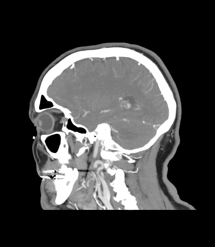 Cerebral dural venous sinus thrombosis (Radiopaedia 86514-102576 C 14).jpg