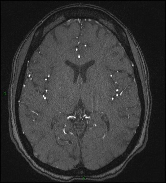 File:Cerebral fat embolism (Radiopaedia 35022-36525 Axial TOF 110).jpg