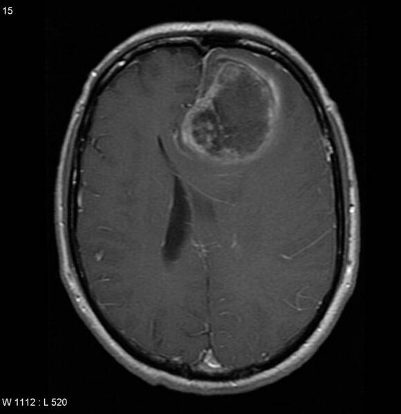 File:Cerebral metastases - renal cell carcinoma (Radiopaedia 5510-7246 Axial T1 C+ 4).jpg