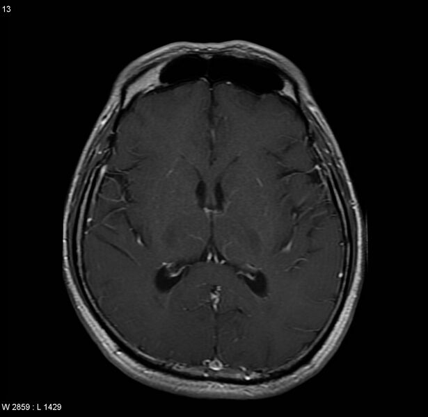 File:Cerebral vasculitis (Radiopaedia 5131-6923 Axial T1 C+ 2).jpg