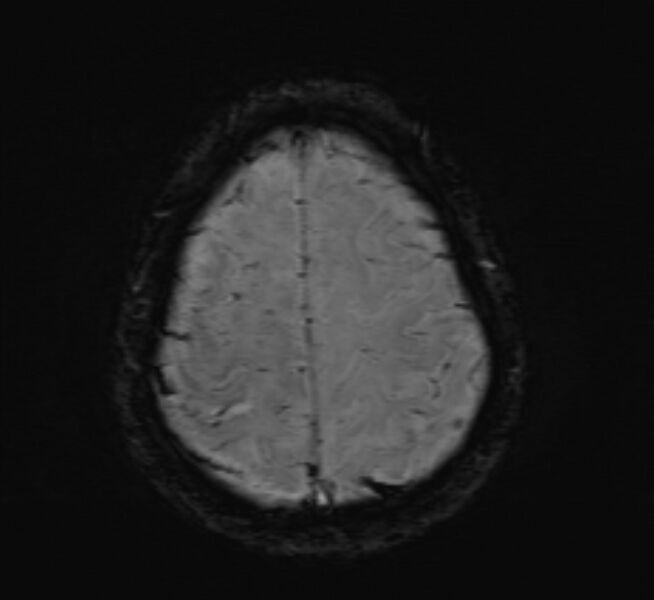 File:Cerebral venous thrombosis (Radiopaedia 71207-81504 Axial SWI 45).jpg