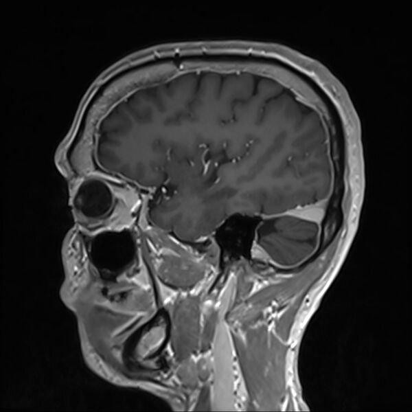 File:Cervical dural CSF leak on MRI and CT treated by blood patch (Radiopaedia 49748-54995 G 19).jpg