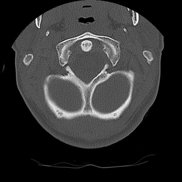 File:Cervical flexion teardrop fracture with cord hemorrhage (Radiopaedia 32497-33454 Axial bone window 13).jpg