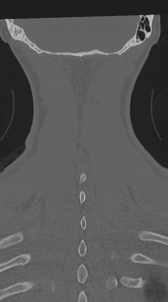 File:Cervical intercalary bone (Radiopaedia 35211-36748 Coronal bone window 67).png