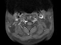 Cervical schwannoma (Radiopaedia 72399-82934 Axial T1 C+ fat sat 1).jpg