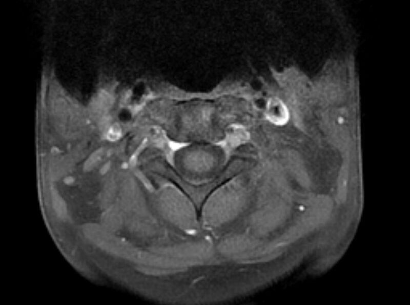 File:Cervical schwannoma (Radiopaedia 72399-82934 Axial T1 C+ fat sat 1).jpg