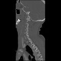 Cervical spine fractures with vertebral artery dissection (Radiopaedia 32135-33078 Sagittal bone window 9).jpg