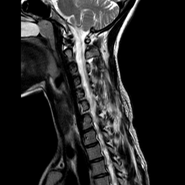 File:Cervical spine posterior ligamentous complex rupture (Radiopaedia 63486-72103 Sagittal T2 9).jpg