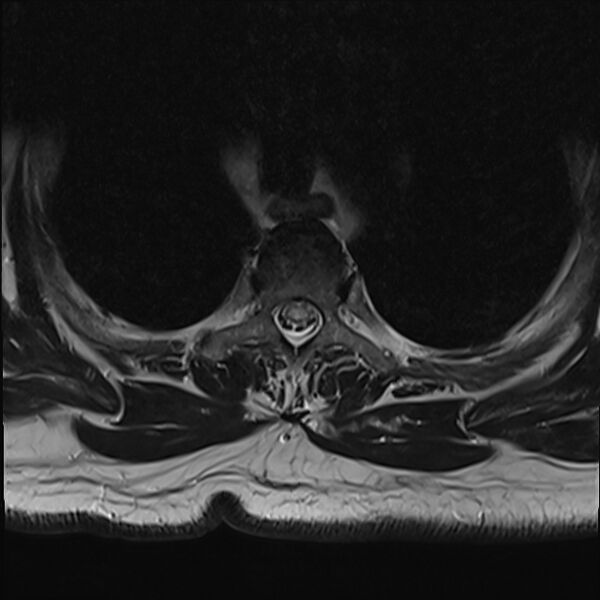 File:Cervical tumor-like myelopathy due to Type V dAVF (Radiopaedia 82461-96604 D 7).jpg