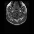 Cervical vertebrae metastasis (Radiopaedia 78814-91667 Axial T1 10).png