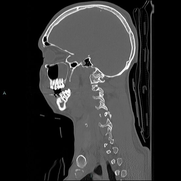 File:Cervical vertebral burst fracture (Radiopaedia 37420-39258 Sagittal bone window 4).jpg