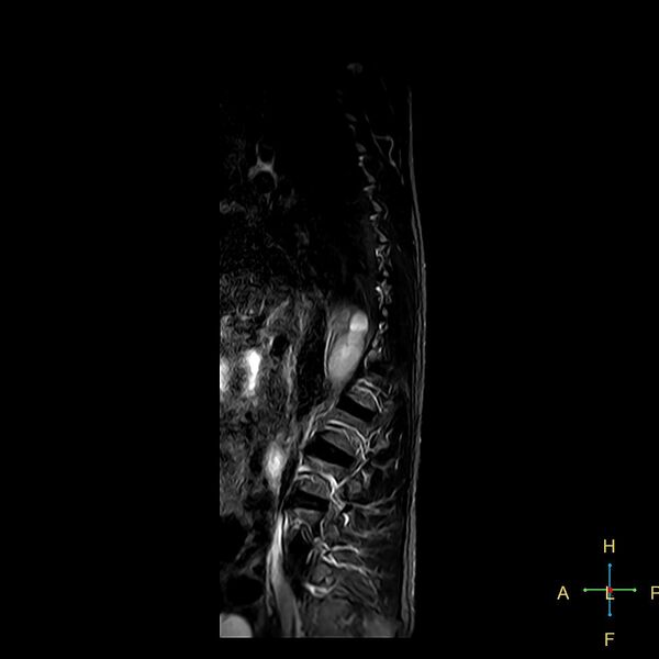 File:Chance fracture of T12 (Radiopaedia 24313-24588 Sagittal STIR 16).jpg