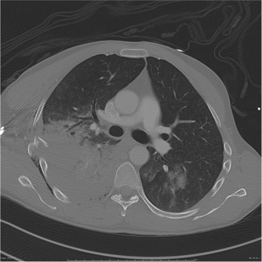 Chest and abdomen multi-trauma (Radiopaedia 26294-26425 bone window 48).jpg