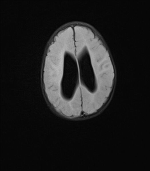 File:Chiari III malformation with occipital encephalocele (Radiopaedia 79446-92559 Axial FLAIR 19).jpg