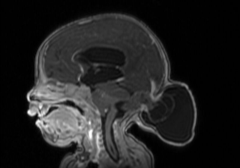 File:Chiari III malformation with occipital encephalocele (Radiopaedia 79446-92559 Sagittal T1 C+ mpr 36).jpg