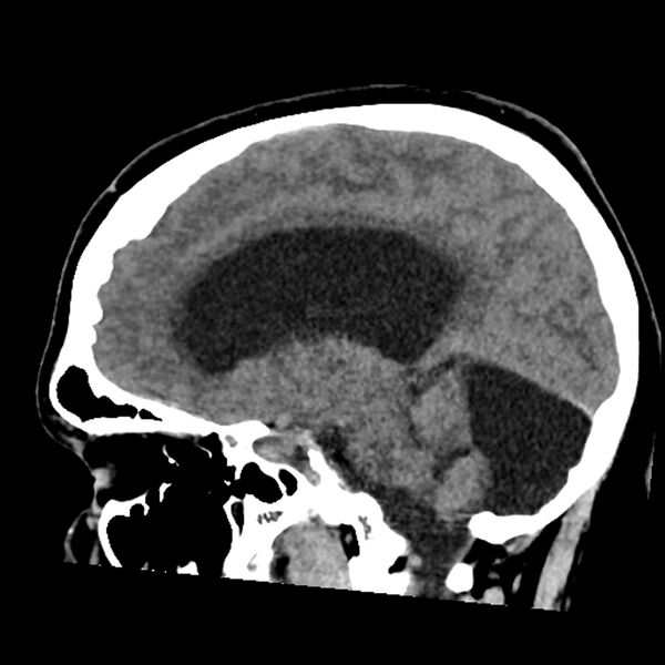 File:Chiasmatic-hypothalamic juvenile pilocytic astrocytoma (Radiopaedia 78533-91237 B 29).jpg