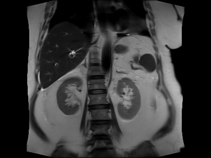 File:Choledocholithiasis causing intrahepatic biliary duct dilation (Radiopaedia 39908-42369 Coronal T2 17).jpg