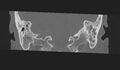 Cholesteatoma (Radiopaedia 10742-11203 Coronal bone window 25).jpg