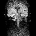 Cholesteatoma (Radiopaedia 10742-11204 Coronal DWI 12).jpg